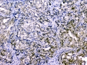 IHC staining of FFPE human stomach cancer with CUL2 antibody at 1ug/ml. HIER: boil tissue sections in pH6, 10mM citrate buffer, for 10-20 min and allow to cool before testing.