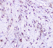 IHC staining of FFPE human endometrial carcinoma with CXCL12 antibody at 0.5ug/ml. HIER: boil tissue sections in pH6, 10mM citrate buffer, for 10-20 min followed by cooling at RT for 20 min.