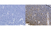 IHC staining of FFPE human lymphoma tissue with CXCL12 antibody (right) and negative control (left) at 1ug/ml. HIER: boil tissue sections in pH8 EDTA buffer for 10-20 min followed by cooling at RT for 20 min.