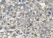 IHC staining of FFPE human liver cancer tissue with CXCL12 antibody at 1ug/ml. HIER: boil tissue sections in pH8 EDTA buffer for 10-20 min followed by cooling at RT for 20 min.
