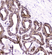 IHC staining of FFPE human cholangiocarcinoma with DDT antibody at 2ug/ml. HIER: boil tissue sections in pH6, 10mM citrate buffer, for 10-20 min followed by cooling at RT for 20 min.