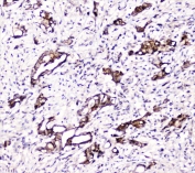 IHC staining of FFPE human intestinal cancer with DDT antibody at 2ug/ml. HIER: boil tissue sections in pH6, 10mM citrate buffer, for 10-20 min followed by cooling at RT for 20 min.