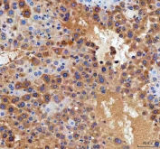 IHC staining of FFPE human intestinal cancer with DDT antibody at 2ug/ml. HIER: boil tissue sections in pH6, 10mM citrate buffer, for 10-20 min followed by cooling at RT for 20 min.