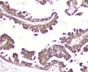 IHC staining of FFPE human ovarian cancer with DDT antibody at 2ug/ml. HIER: boil tissue sections in pH6, 10mM citrate buffer, for 10-20 min followed by cooling at RT for 20 min.
