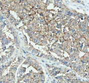 IHC staining of FFPE human ovarian cancer with DDT antibody at 2ug/ml. HIER: boil tissue sections in pH6, 10mM citrate buffer, for 10-20 min followed by cooling at RT for 20 min.