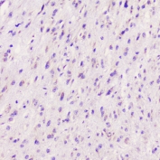 IHC staining of FFPE human glioma with ELAVL2 antibody at 1ug/ml. HIER: boil tissue sections in pH6, 10mM citrate buffer, for 10-20 min followed by cooling at RT for 20 min.
