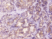 IHC staining of FFPE human stomach cancer with EML4 antibody at 1ug/ml. HIER: boil tissue sections in pH6, 10mM citrate buffer, for 10-20 min followed by cooling at RT for 20 min.