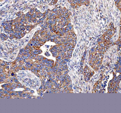 IHC staining of FFPE human ovarian serous adenocarcinoma tissue with EML4 antibody. HIER: boil tissue sections in pH8 EDTA for 20 min and allow to cool before testing.