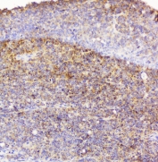 IHC staining of FFPE human sarcoma with EML4 antibody at 1ug/ml. HIER: boil tissue sections in pH6, 10mM citrate buffer, for 10-20 min followed by cooling at RT for 20 min.