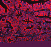 Immunofluorescent staining of FFPE human colorectal cancer tissue with EML4 antibody (red) and DAPI nuclear stain (blue). HIER: steam section in pH8 EDTA buffer for 20 min.