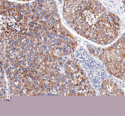 IHC staining of FFPE human liver cancer tissue with EML4 antibody. HIER: boil tissue sections in pH8 EDTA for 20 min and allow to cool before testing.