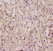 IHC staining of FFPE human appendicitis with EML4 antibody at 1ug/ml. HIER: boil tissue sections in pH6, 10mM citrate buffer, for 10-20 min followed by cooling at RT for 20 min.