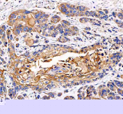 IHC staining of FFPE human esophageal squamous carcinoma tissue with EML4 antibody. HIER: boil tissue sections in pH8 EDTA for 20 min and allow to cool before testing.