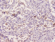 IHC staining of FFPE human lung cancer with EML4 antibody at 1ug/ml. HIER: boil tissue sections in pH6, 10mM citrate buffer, for 10-20 min followed by cooling at RT for 20 min.