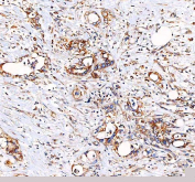 IHC staining of FFPE human colorectal adenocarcinoma tissue with EML4 antibody. HIER: boil tissue sections in pH8 EDTA for 20 min and allow to cool before testing.