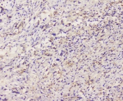 IHC staining of FFPE human rectal cancer with EML4 antibody at 1ug/ml. HIER: boil tissue sections in pH6, 10mM citrate buffer, for 10-20 min followed by cooling at RT for 20 min.