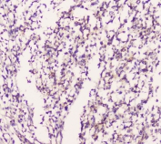 IHC staining of FFPE human glioma with EML4 antibody at 1ug/ml. HIER: boil tissue sections in pH6, 10mM citrate buffer, for 10-20 min followed by cooling at RT for 20 min.
