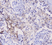 IHC staining of FFPE human lung cancer with NSE antibody at 1ug/ml. HIER: boil tissue sections in pH6, 10mM citrate buffer, for 10-20 min followed by cooling at RT for 20 min.