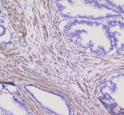 IHC staining of FFPE human pancreatic cancer with NSE antibody at 1ug/ml. HIER: boil tissue sections in pH6, 10mM citrate buffer, for 10-20 min followed by cooling at RT for 20 min.