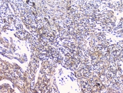 IHC staining of FFPE human lung cancer with CD32 antibody at 1ug/ml. HIER: boil tissue sections in pH6, 10mM citrate buffer, for 10-20 min followed by cooling at RT for 20 min.