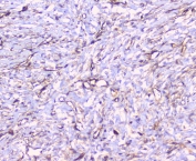 IHC staining of FFPE human breast cancer with CD32 antibody at 1ug/ml. HIER: boil tissue sections in pH6, 10mM citrate buffer, for 10-20 min followed by cooling at RT for 20 min.