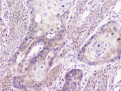 IHC staining of FFPE human esophagus squama cancer with GM130 antibody at 0.5ug/ml. HIER: boil tissue sections in pH6, 10mM citrate buffer, for 10-20 min followed by cooling at RT for 20 min.