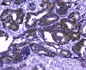 IHC staining of FFPE human intestinal cancer tissue with GOLPH3 antibody. HIER: boil tissue sections in pH8 EDTA for 20 min and allow to cool before testing.