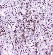 IHC staining of FFPE human appendicitis with HMGN2 antibody at 2ug/ml. HIER: boil tissue sections in pH6, 10mM citrate buffer, for 10-20 min followed by cooling at RT for 20 min.