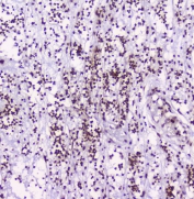 IHC staining of FFPE human appendicitis with HMGN2 antibody at 2ug/ml. HIER: boil tissue sections in pH6, 10mM citrate buffer, for 10-20 min followed by cooling at RT for 20 min.