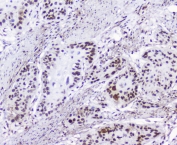 IHC staining of FFPE human esophagus squama cancer with HMGN2 antibody at 2ug/ml. HIER: boil tissue sections in pH6, 10mM citrate buffer, for 10-20 min followed by cooling at RT for 20 min.