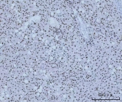 IHC staining of FFPE human liver cancer tissue with HMGN2 antibody. HIER: boil tissue sections in pH8 EDTA for 20 min and allow to cool before testing.
