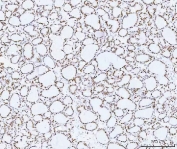 IHC staining of FFPE human thyroid cancer tissue with HMGN2 antibody. HIER: boil tissue sections in pH8 EDTA for 20 min and allow to cool before testing.