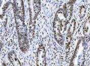 IHC staining of FFPE human rectal cancer tissue with HMGN2 antibody. HIER: boil tissue sections in pH8 EDTA for 20 min and allow to cool before testing.