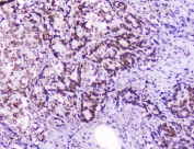 IHC staining of FFPE human stomach cancer with HMGN2 antibody at 2ug/ml. HIER: boil tissue sections in pH6, 10mM citrate buffer, for 10-20 min followed by cooling at RT for 20 min.