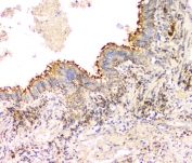 IHC staining of FFPE human lung cancer with IFNG antibody at 1ug/ml. HIER: boil tissue sections in pH6, 10mM citrate buffer, for 10-20 min and allow to cool before testing.