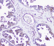 IHC staining of FFPE human ovarian cancer with SHIP2 antibody at 1ug/ml. HIER: boil tissue sections in pH6, 10mM citrate buffer, for 10-20 min followed by cooling at RT for 20 min.