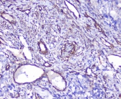 IHC staining of FFPE human stomach cancer with SHIP2 antibody at 1ug/ml. HIER: boil tissue sections in pH6, 10mM citrate buffer, for 10-20 min followed by cooling at RT for 20 min.