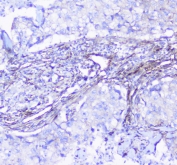 IHC staining of FFPE human lung cancer with SHIP2 antibody at 1ug/ml. HIER: boil tissue sections in pH6, 10mM citrate buffer, for 10-20 min followed by cooling at RT for 20 min.