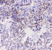 IHC staining of FFPE human lung cancer with ITGA3 antibody at 1ug/ml. HIER: boil tissue sections in pH6, 10mM citrate buffer, for 10-20 min followed by cooling at RT for 20 min.