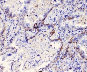 IHC staining of FFPE human lung cancer with ITGA3 antibody at 1ug/ml. HIER: boil tissue sections in pH6, 10mM citrate buffer, for 10-20 min followed by cooling at RT for 20 min.