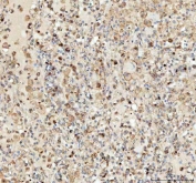 IHC staining of FFPE human lung cancer tissue with LMAN1 antibody. HIER: boil tissue sections in pH8 EDTA buffer, for 10-20 min followed by cooling at RT for 20 min.