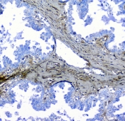 IHC staining of FFPE human ovarian cancer with LUM antibody at 1ug/ml. HIER: boil tissue sections in pH6, 10mM citrate buffer, for 10-20 min followed by cooling at RT for 20 min.