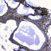 IHC staining of FFPE human pancreatic cancer with LUM antibody at 1ug/ml. HIER: boil tissue sections in pH6, 10mM citrate buffer, for 10-20 min followed by cooling at RT for 20 min.