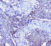 IHC staining of FFPE human lung cancer with LUM antibody at 1ug/ml. HIER: boil tissue sections in pH6, 10mM citrate buffer, for 10-20 min followed by cooling at RT for 20 min.