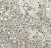 IHC staining of FFPE human liver cancer tissue with NOVA1 antibody. HIER: boil tissue sections in pH8 EDTA for 20 min and allow to cool before testing.