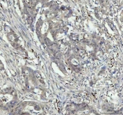 IHC staining of FFPE human colorectal adenocarcinoma tissue with NOVA1 antibody. HIER: boil tissue sections in pH8 EDTA for 20 min and allow to cool before testing.
