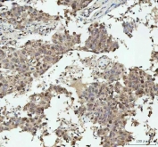 IHC staining of FFPE human breast cancer tissue with NOVA1 antibody. HIER: boil tissue sections in pH8 EDTA for 20 min and allow to cool before testing.