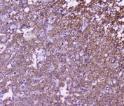 IHC staining of FFPE human glioma with SNAP25 antibody at 2ug/ml. HIER: boil tissue sections in pH6, 10mM citrate buffer, for 10-20 min followed by cooling at RT for 20 min.