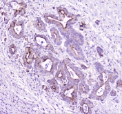 IHC staining of FFPE human cholangiocarcinoma with TANK antibody at 1ug/ml. HIER: boil tissue sections in pH6, 10mM citrate buffer, for 10-20 min followed by cooling at RT for 20 min.