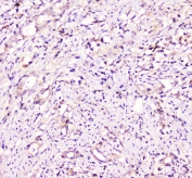 IHC staining of FFPE human rectal cancer with TANK antibody at 1ug/ml. HIER: boil tissue sections in pH6, 10mM citrate buffer, for 10-20 min followed by cooling at RT for 20 min.